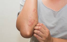 Eczema Skin Infection
